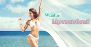 What is Liposuction and Which People Can Benefit from This Method?